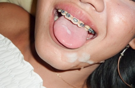 teen braces top photo